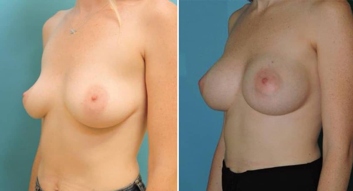 Breast-Aug-2a-female