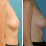 Thumbnail of http://snyder%20before%20and%20after%20breast%20augmentation%20procedure