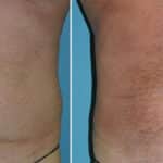 Thumbnail of http://Liposuction%20before%20and%20after%20patient