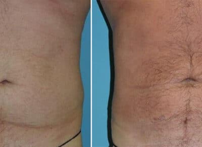 Liposuction Patient – 2