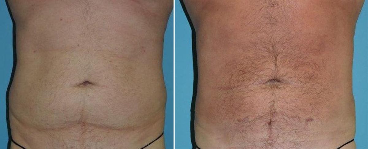 Liposuction before and after patient