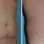 Thumbnail of http://Liposuction%20before%20and%20after%20patient