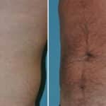 Thumbnail of http://Liposuction%20before%20and%20after%20patient