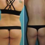 Thumbnail of http://Liposuction%20before%20and%20after%20patient