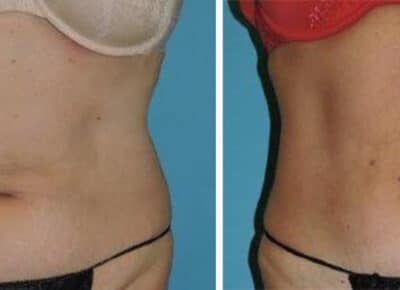 Liposuction Patient