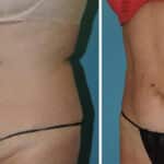 Thumbnail of http://Liposuction%20before%20and%20after%20patient