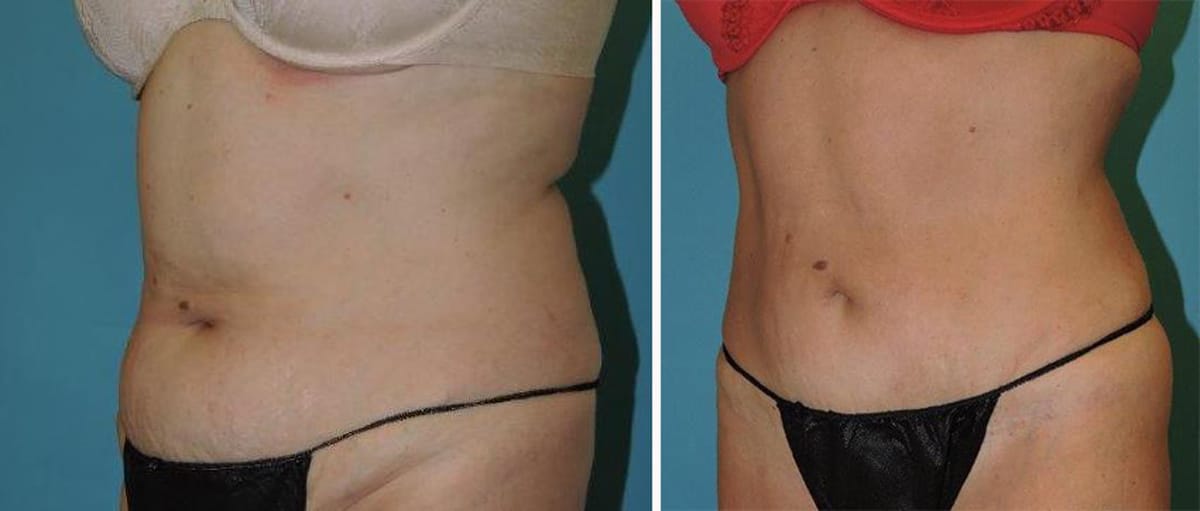 Liposuction-2a-female