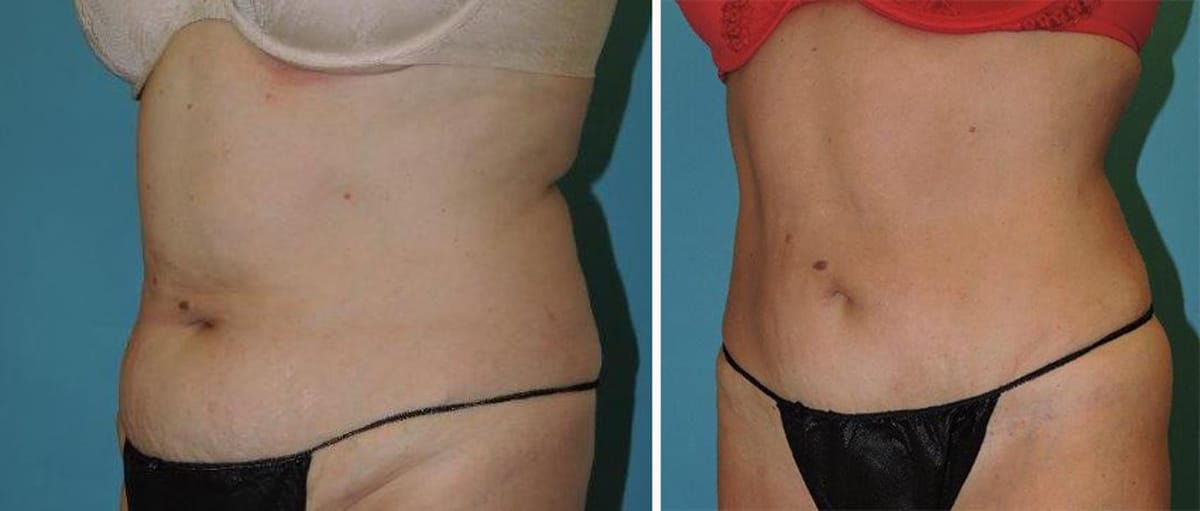 Liposuction before and after patient