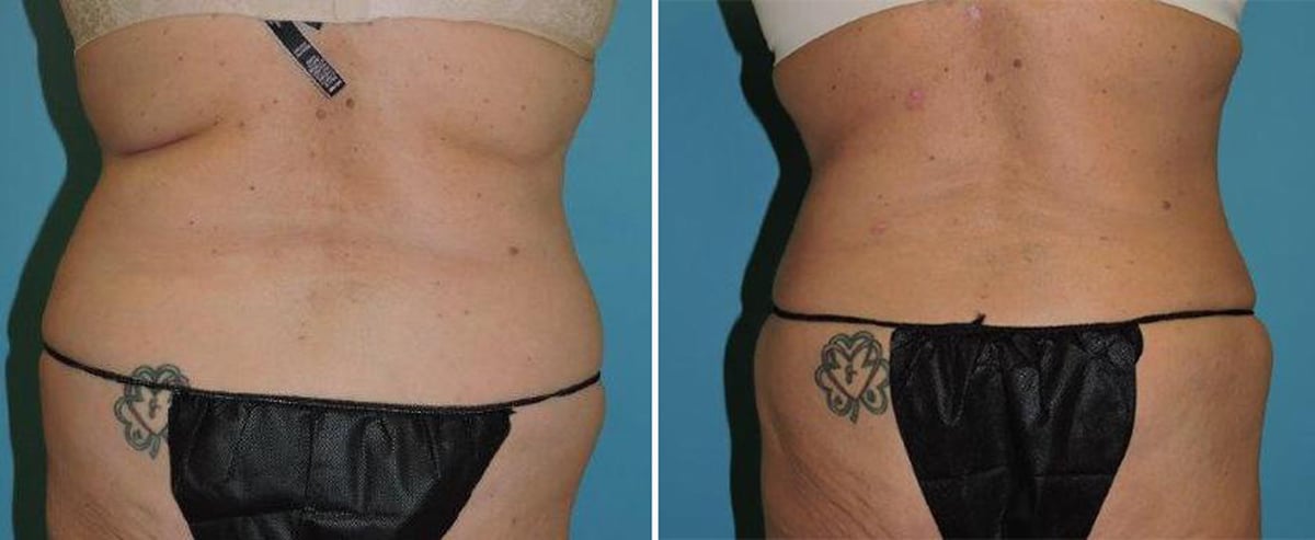 Liposuction before and after patient