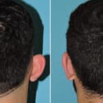 Thumbnail of http://otoplasty%20before%20and%20after