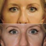 Thumbnail of http://blepharoplasty%20before%20and%20after%20patient