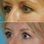 Thumbnail of http://blepharoplasty%20before%20and%20after%20patient