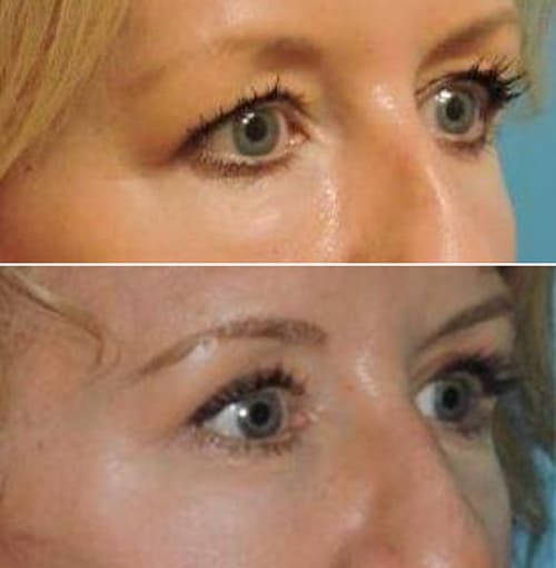 blepharoplasty before and after patient