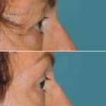 Thumbnail of http://blepharoplasty%20before%20and%20after%20patient