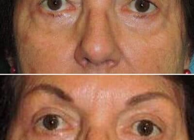 Blepharoplasty Patient – 7