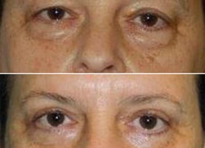 Blepharoplasty Patient – 13