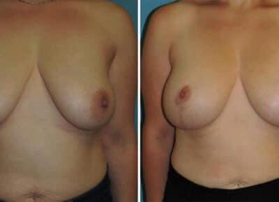 Breast Lift with Implants Patient