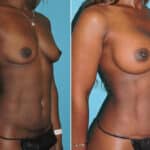 Thumbnail of http://snyder%20before%20and%20after%20breast%20augmentation%20procedure