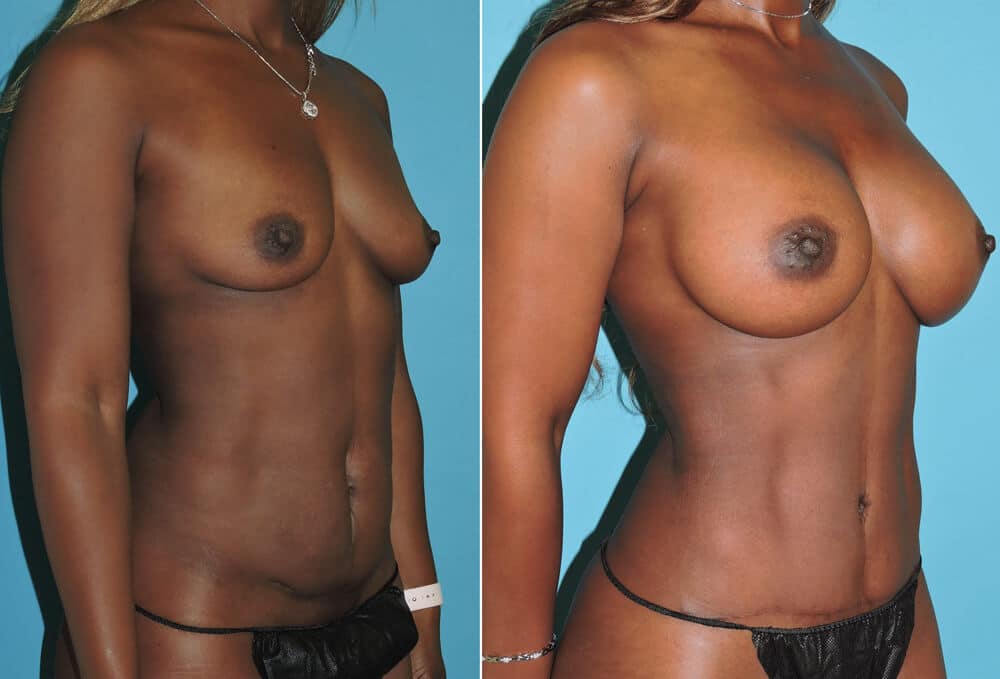 snyder before and after breast augmentation procedure