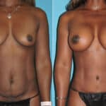 Thumbnail of http://snyder%20before%20and%20after%20breast%20augmentation%20procedure