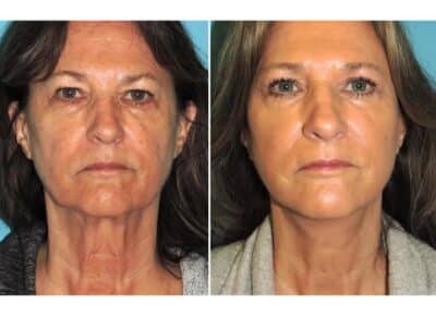 Facelift Patient – 6