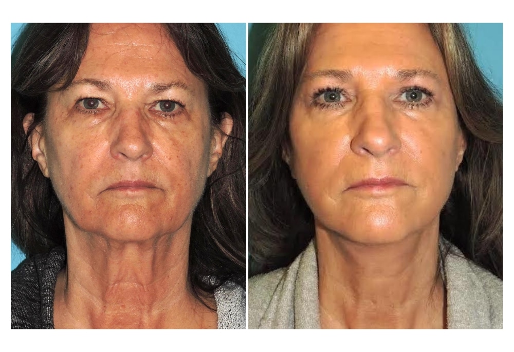 snyder before and after Face and neck lift procedure