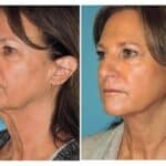 Thumbnail of http://snyder%20before%20and%20after%20Face%20and%20neck%20lift%20procedure