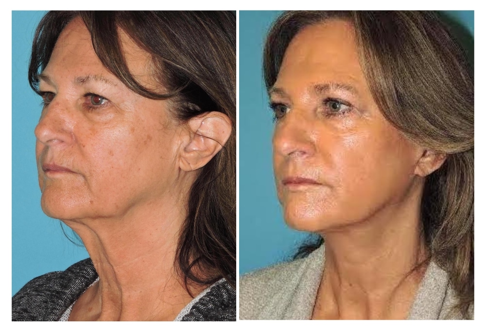 snyder before and after Face and neck lift procedure