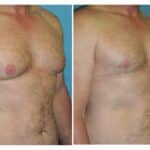 Thumbnail of http://snyder%20before%20and%20after%20male%20liposuction%20and%20areola%20reduction%20procedure