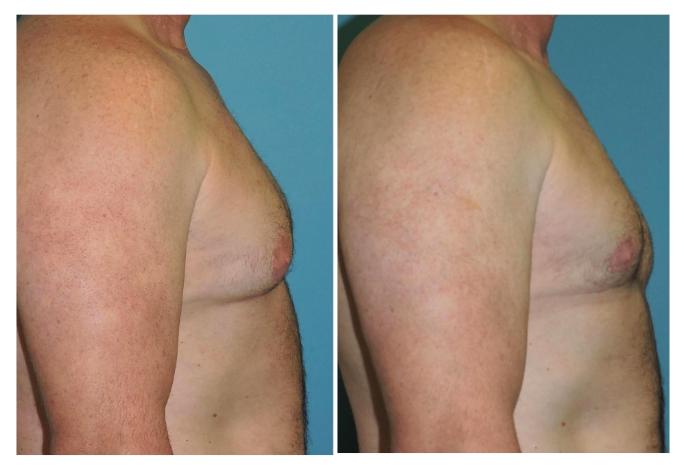 snyder before and after male liposuction and areola reduction procedure