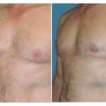 Thumbnail of http://snyder%20before%20and%20after%20male%20liposuction%20and%20areola%20reduction%20procedure