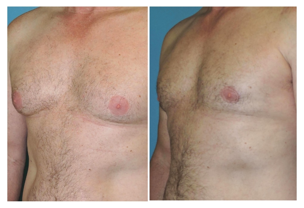 snyder before and after male liposuction and areola reduction procedure