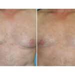 Thumbnail of http://snyder%20before%20and%20after%20male%20liposuction%20and%20areola%20reduction%20procedure