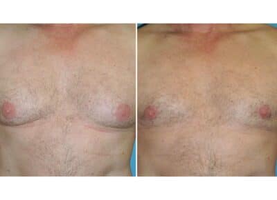 Liposuction and Areola Reduction Patient – 1