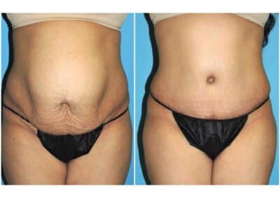 Abdominoplasty Dr Snyder 1