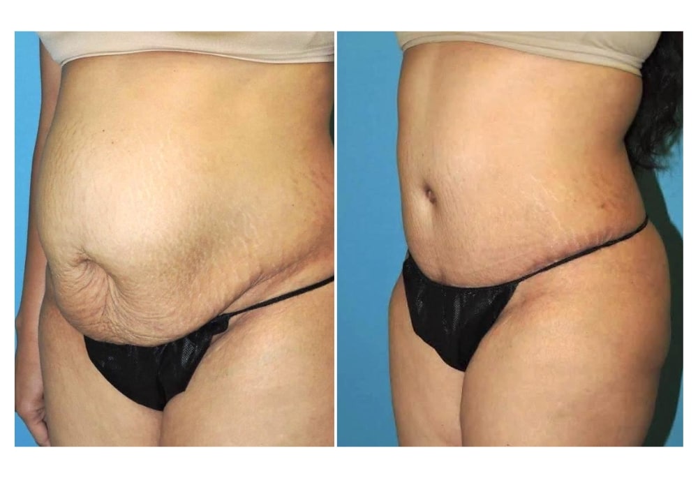snyder before and after Tummy Tuck procedure