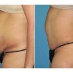 Thumbnail of http://snyder%20before%20and%20after%20Tummy%20Tuck%20procedure