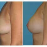 Thumbnail of http://snyder%20before%20and%20after%20breast%20augmentation%20procedure