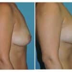 Thumbnail of http://snyder%20before%20and%20after%20breast%20augmentation%20procedure