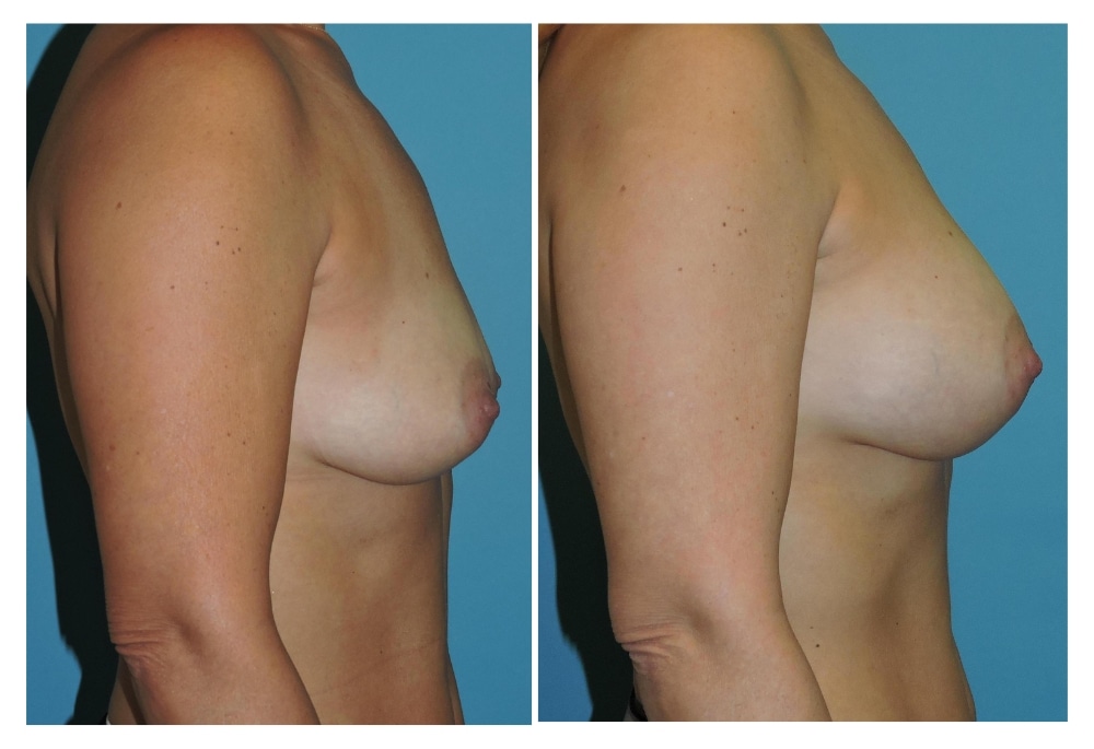 snyder before and after breast augmentation procedure