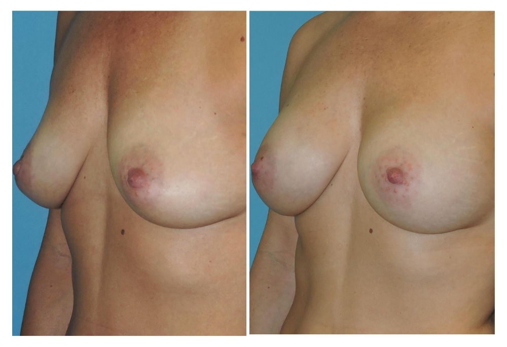 snyder before and after breast augmentation procedure