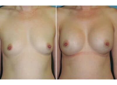 Breast Augmentation Patient – 16
