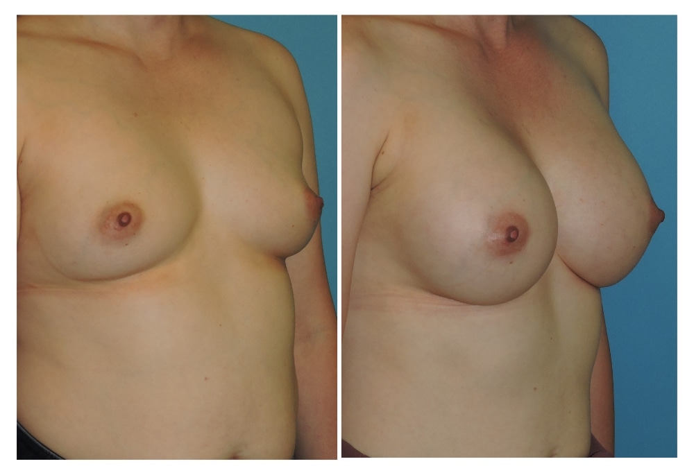 snyder before and after breast augmentation procedure