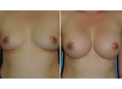 Breast Augmentation Patient – 17