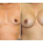 Thumbnail of http://snyder%20before%20and%20after%20breast%20augmentation%20procedure