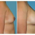 Thumbnail of http://snyder%20before%20and%20after%20breast%20augmentation%20procedure