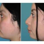 Thumbnail of http://snyder%20before%20and%20after%20rhinoplasty%20procedure