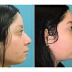 Thumbnail of http://snyder%20before%20and%20after%20rhinoplasty%20procedure