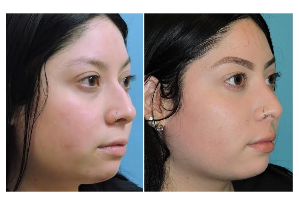snyder before and after rhinoplasty procedure