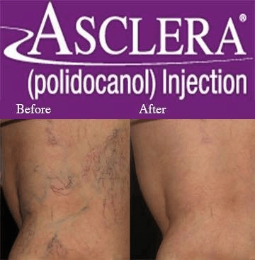 asclera-vein-removal